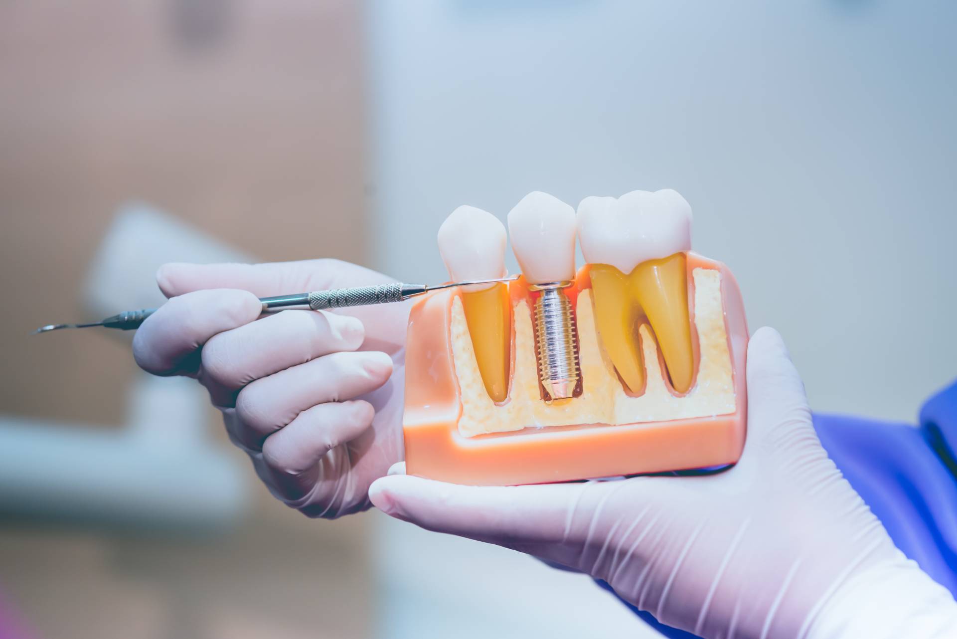 dental implants advancement 3